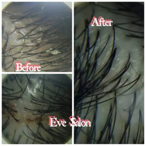 Salon Membersihkan Ketombe Di Depok