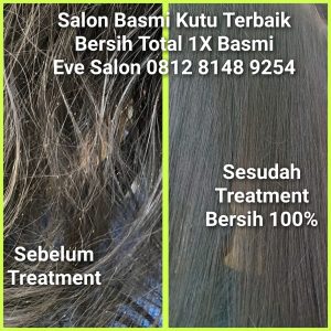 dimana tempat hilangkan kutu anak